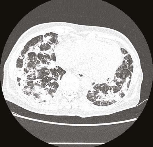 Nález nejspíše odpovídá fenotypu organizující se pneumonie nitrofurantoinu, minocyklinu, solí zlata, sulfasalazinu, amiodaronu, acebutolu, atenololu, propanololu, flecainidu, diphenylhydantoinu nebo