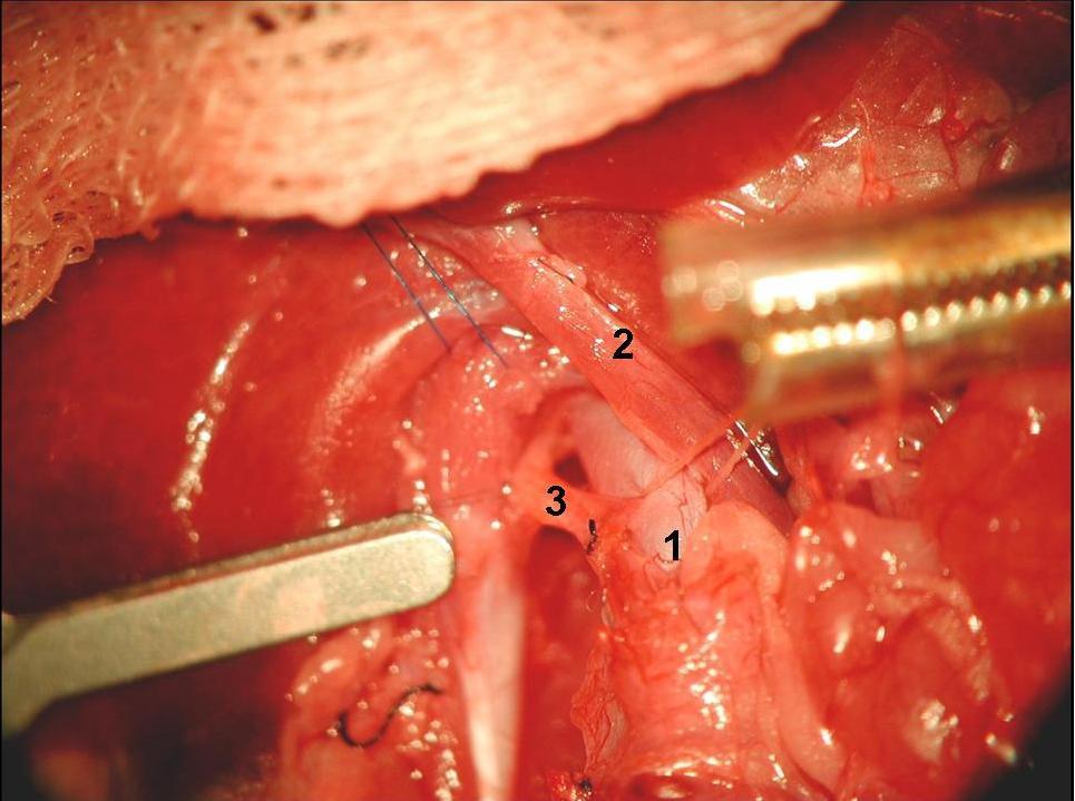 Obr. č. 21- Stav před perfuzí, uvolněná aorta (1), vena portae (2) a ductus thoracicus (3) Podvážeme aortu kraniálně od bifurkace a kraniálně od odstupu a.celiaca.