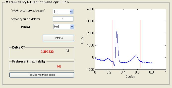 konkrétní srdeční cyklus. Je zde tedy zobrazena příslušná délka intervalu a detekováno překročení. Obrázek 9.