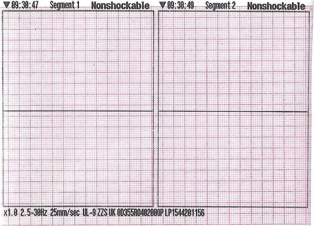 Cmorej PCH, et al. Neadekvátní výboje... asystolie. Výboje byly aplikovány navzdory programovému nastavení zóny podmíněného výboje a zóny výboje na 200, respektive 230 tepů za minutu.