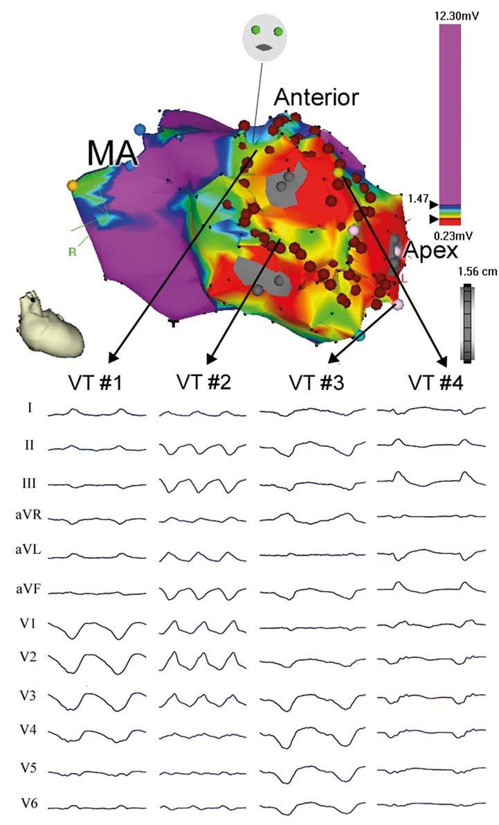 Obr. 1. Příklad mapování arytmogenního substrátu po infarktu myokardu. V horní části obrázku je zobrazena elektroanatomická endokardiální mapa levé komory v předozadní projekci.