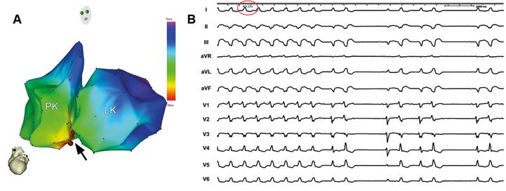 Obr. 2. Mapování a ablace KT u pacienta s neischemickou kardiomyopatií. (A) Elektroanatomická aktivační mapa obou srdečních komor u pacienta s incesantní pomalou KT.