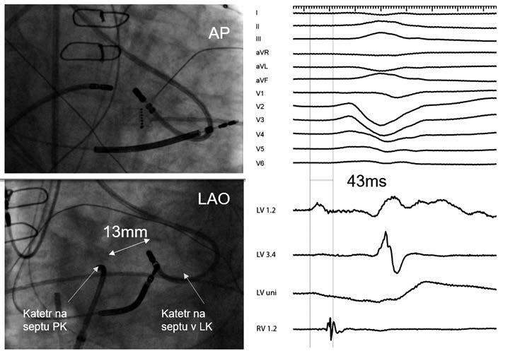Obr. 6. Rtg snímky v předozadní (AP) a levé šikmé projekci (LAO) zobrazující bipolární ablaci u pacienta s arytmogenním substrátem umístěným v hloubce mezikomorového septa.