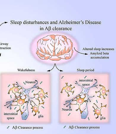 Spánkové poruchy a beta-amyloid vysvětlení poruch spánku AN: 1) pálení neuronů produkce Abeta pomalovlnný spánek oproti bdělosti pálení neuronů produkce Abeta poruchy spánku bdělost, NREM celkové