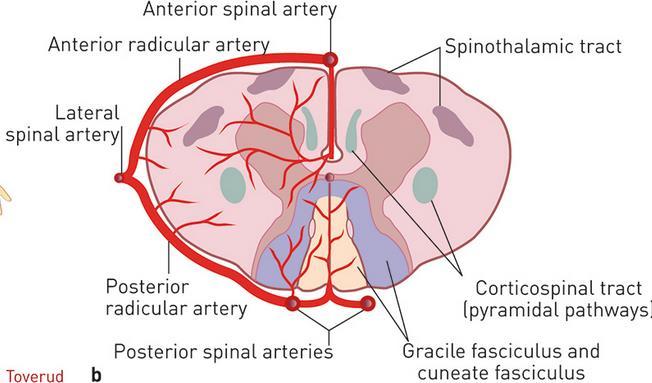 : Spinal cord ischemia after stent graft treatment for