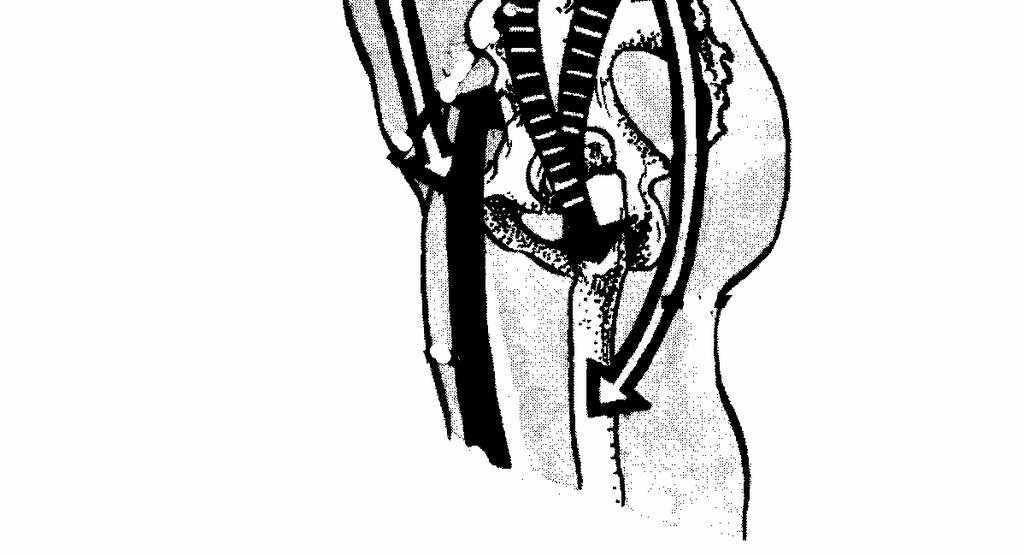 tensor fasciae latae), vzpřimovače trupu, a to v lumbosakrálních segmentech-st, nikoliv hrudních. Dochází k útlumu a oslabení v gluteálních svalech, a to jak v m.