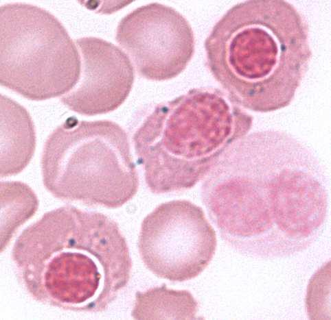 CYTOCHEMICKÉ NÁLEZY V MORFOLOGICKÉM HODNOCENÍ DŘENĚ Perlsovo barvení počet prstenčitých sideroblastů