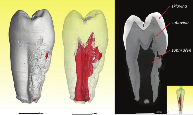 JAKÉ MOŽNOSTI CT PŘINÁŠÍ Využití microct ve stomatologii při autotransplantacích Autotransplantace zubů je velmi vhodnou moderní technikou, která umožňuje obnovit úsměv pacientů.