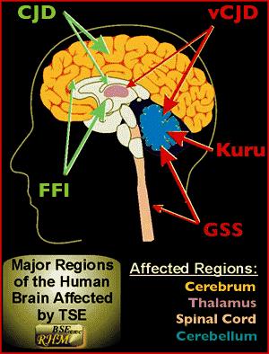 Kde působí priony v mozku Creutzfeld Jacobova choroba degenerativní onemocnění mozku člověka.