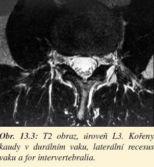 Zobrazovací metody Skiagrafie celkové zhodnocení tíže degenerativních