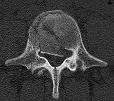 struktury skeletu zobrazení meziobratlových plotének a páteřního