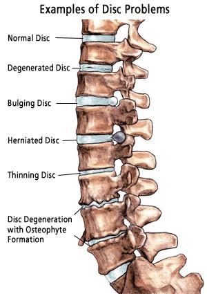 Anatomické aspekty degenerativních změn páteře Spondylóza obecný termín vyjadřující Přítomnost