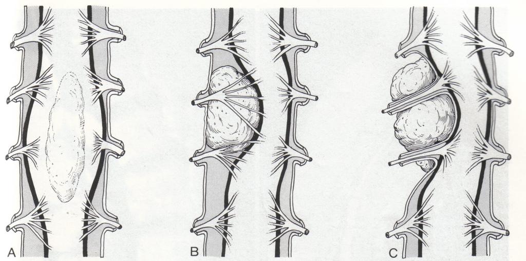 Anatomické aspekty expanzivních procesů páteře a míchy A. Intradurální, Intramedulární astrocytom, ependymom, hemangiom, cavernom, dermoid/epidermoid B.