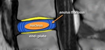 Spojení obratlů Articulationes intervertebrales mezi processus articulares - 23 intervertebrálních disků - ploténka není