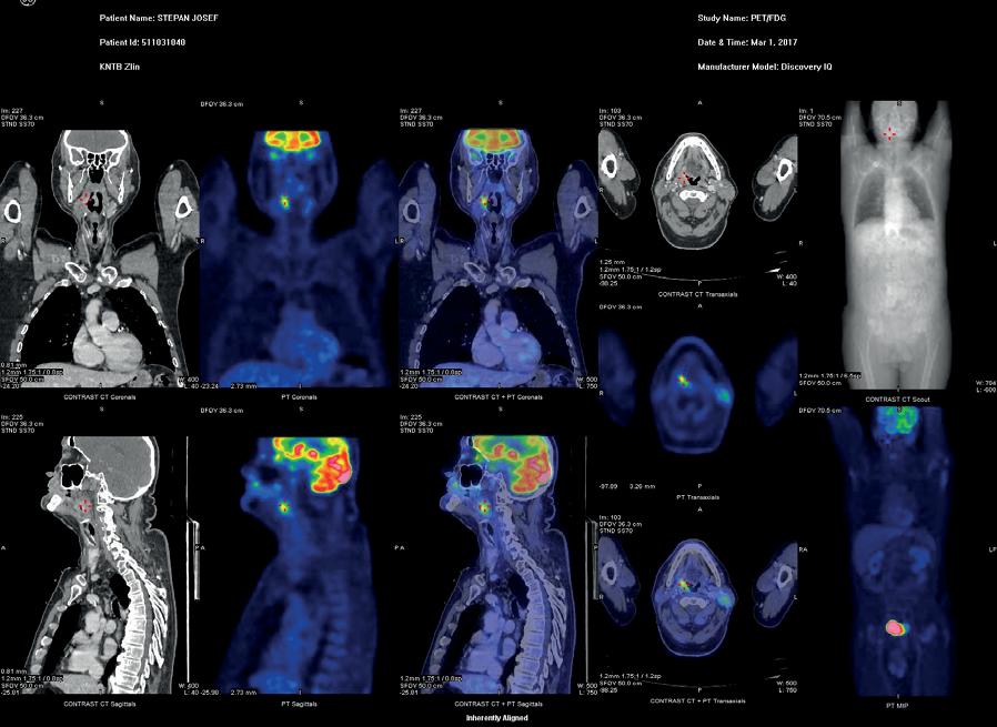 Histologicky byl potvrzen opět středně diferencovaný rohovějící spinocelulární karcinom p 16 negativní, dle doplněného stagingu bez vzdálených metastáz.