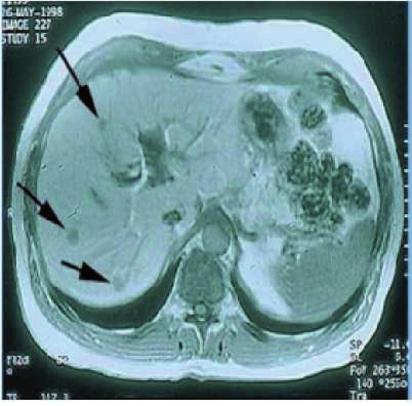 Játra s nádorovými ložisky (označenými šipkami) při vyšetření magnetickou rezonancí.
