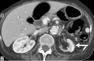 ledvinu A: CT břicha