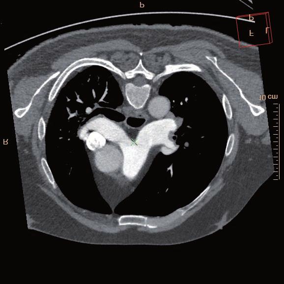 Dle kontrolní echokardiografie provedené zhruba rok po první hospitalizaci přetrvávala plicní hypertenze s odhadovaným systolickým tlakem v plicnici 55 mmhg.