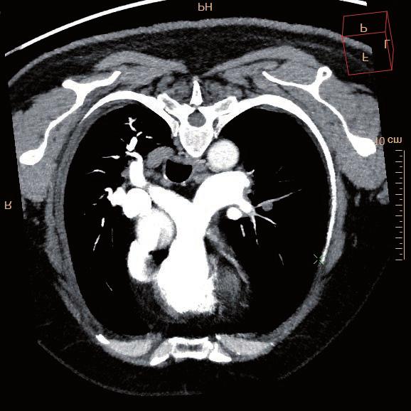 Pacient byl vzhledem k trvajícím obtížím a zejména na základě plicní angiografie a pravostranné srdeční katetrizace indikován k plicní endarterektomii (obr. 15). Operace proběhla Obr.