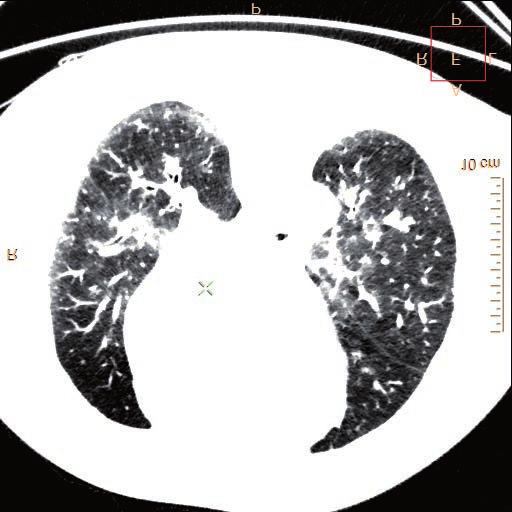 13: Obraz oslabené atenuace v plicním parenchymu distálně za obstrukcí plicních cév (mozaikovitý vzhled plicního parenchymu) za rok po první hospitalizaci.