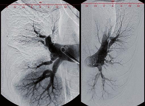 ENDARTEREKTOMIE PLICNICE METODA VOLBY V LÉČBĚ CHRONICKÉ TROMBOEMBOLICKÉ Obr. 1: Předoperační angiografie plicnice Obr.