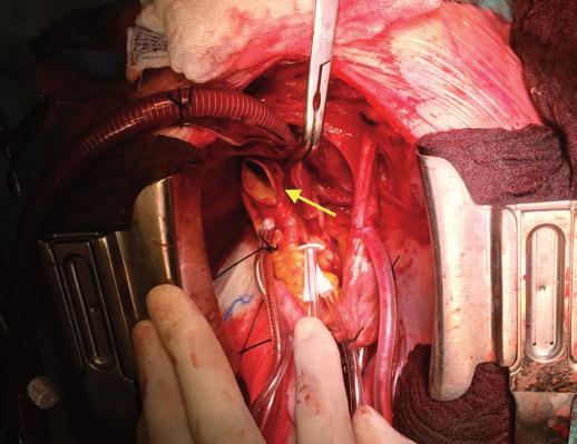 (obr. 1), byla potvrzena diagnóza CTEPH. Následně byl pacient prezentován na CTEPH semináři Komplexního kardiovaskulárního centra VFN (KKVC) a indikován k plicní endarterektomii (PEA).