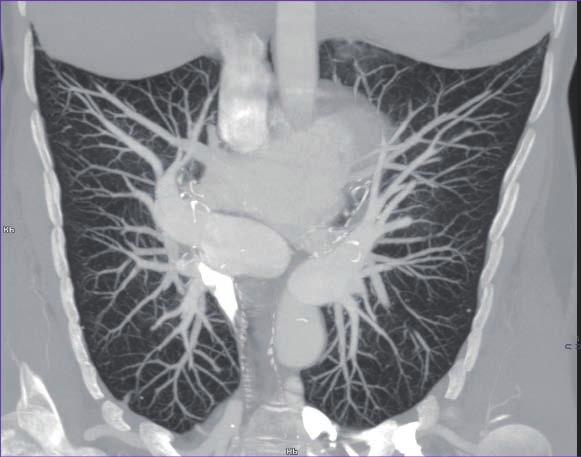 Bylo provedeno echokardiografické vyšetření s nálezem těžké plicní hypertenze, odhadovaný systolický tlak v plicnici okolo 96 mmhg.