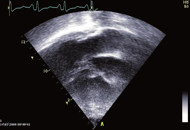 AKUTNÍ PLICNÍ EMBOLIE V TERÉNU CHRONICKÉ TROMBOEMBOLICKÉ PLICNÍ HYPERTENZE catheterisation that exactly quantifies the extent of PH and determines its type.