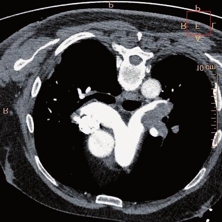 4: Obraz akutního plicního embolu na CT vyšetření provedeném před aplikací trombolytické léčby zánětlivých parametrů při plicním infarktu byla nasazena antibiotická léčba.