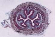 horní, dolní zadní mediastinum Jícen (Oesophagus) Zúžení jícnu