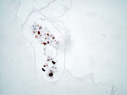 High-grade urothelial carcinoma, expression of Ki-67 in tissue section (A) and in cell block section (B) and expression of p53 in tissue section (C) and in cell block section (D), magnification 400