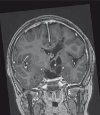 Kazuistika 2: Dívka ročník 2005 s inoperabilním supraselárním pilocytárním astrocytomem (chiasma, hypotalamus) po bio psii (mutace BRAFV600E prokázána metodou ASO-PCR;
