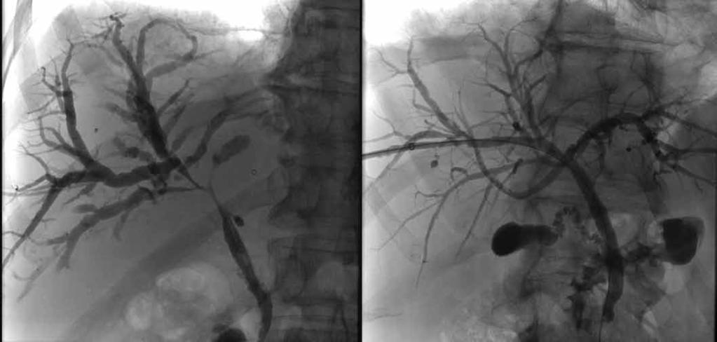 Obr. 7. Cholangiografie před a po léčbě kortikosteroidy.