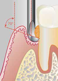 c) inserce - postupné zavedení nástroje na dno parodontálního chobotu d) scaling - odstranění zubního kamene koronárním tahem e) root planning - ohlazování povrchu kořene s delšími pohyby a nižším