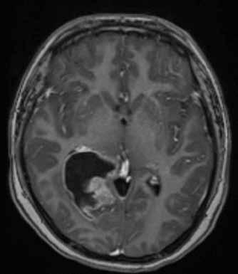 w841fs genu PMS2 v heterozygotním stavu, a tím potvrzen bialelický CMMR-D s autozomálně recesivním typem dědičnosti (obr. 1, 2). Rodinná studie nalezla heterozygotní mutaci c.2t>a/ p.