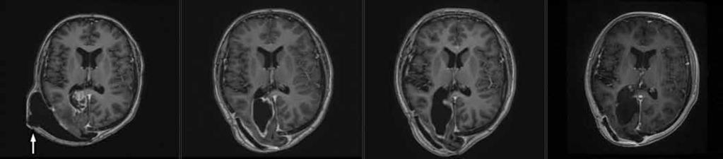 A B C D Obr. 4. MRI, T1 vážené obrazy s kontrastem pokračující léčebná odpověď.