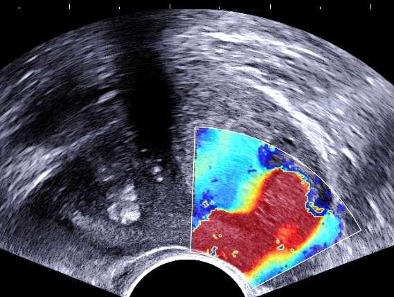 Share Wave Elastography versus RAPE N = 38 pacientů s pozitivním nálezem v preparátu Supersonic Airexplorer K