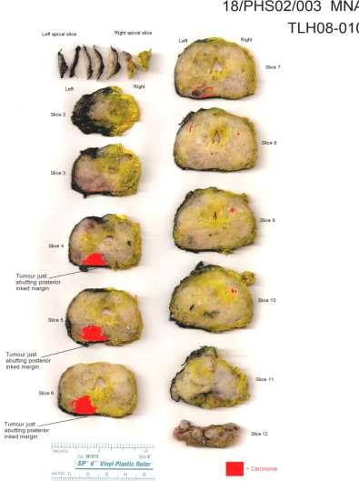 Analýza 1200 řezů po radikální prostatektomii metodou Bostwick Laboratory 87% bylo