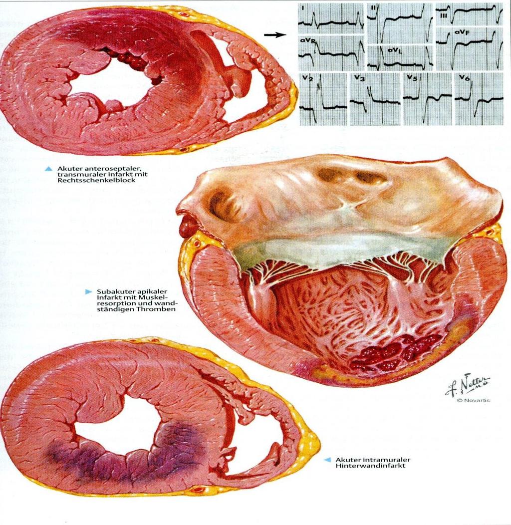 Infarkt