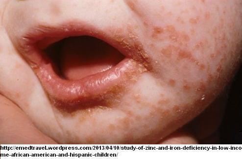 enteropatica- dědičné onemocnění, snížená absorpce Zn, kožní projevy POZOR u
