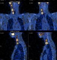 131 I SPECT/CT se