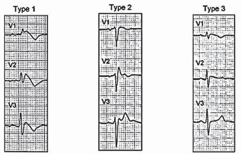 Typ 2: sedlovitá elevace úseku ST o více než 2 mm s následnou buď pozitivní, nebo bifázickou vlnou T, dříve používaný termín EKG obraz 3.