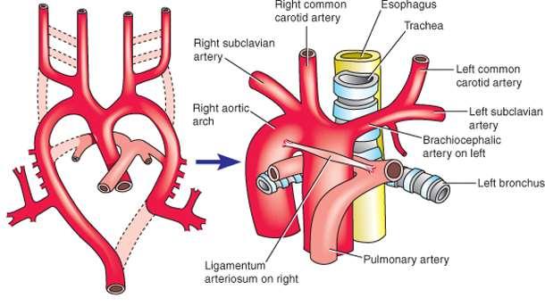 Arcus aortae dexter, pravý aortální oblouk,