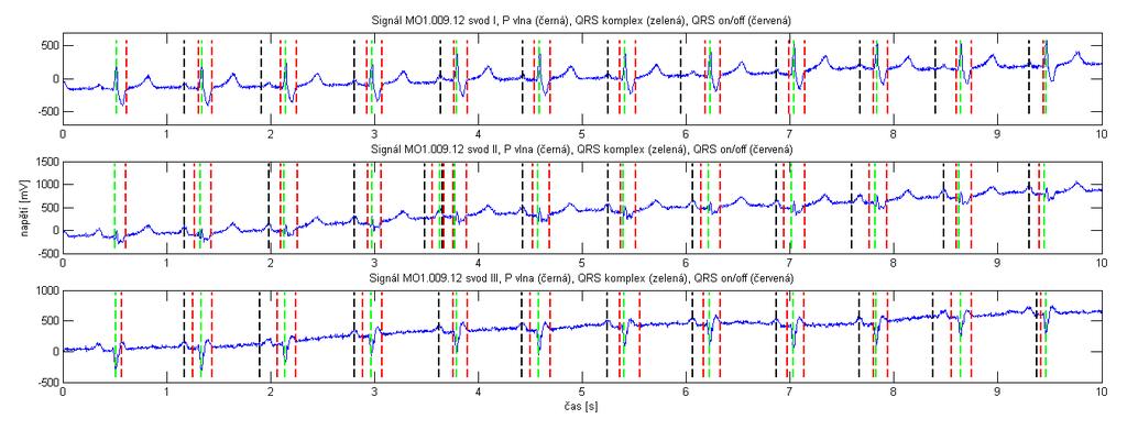 Obr. 32: Ukázka rozměření signálu M01_009_12 (svody I, II, III) Na Obr. 33 jsou zobrazeny signály MO1_065_12 svody I, V1 a V2. U svodu I můžeme vidět totální selhání detekce.