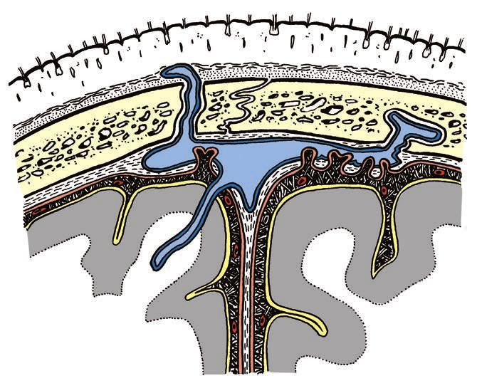 10 Regions of the head, regiones capitis scribed together. Their base is formed by the cranial vault, the calvaria, covered by soft tissues the scalp (Fig. 1.2).