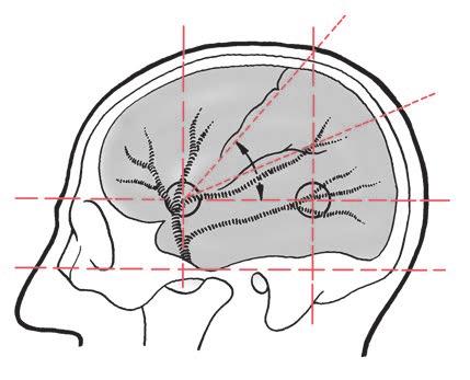 The brain case 11 3 4 2 5 6 7 8 Fig. 1.3 Projection of the anterior and posterior branches of the middle meningeal artery (circles) and central and lateral sulcus of the brain.