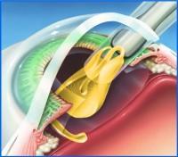 Příloha D Implantace nitrooční čočky