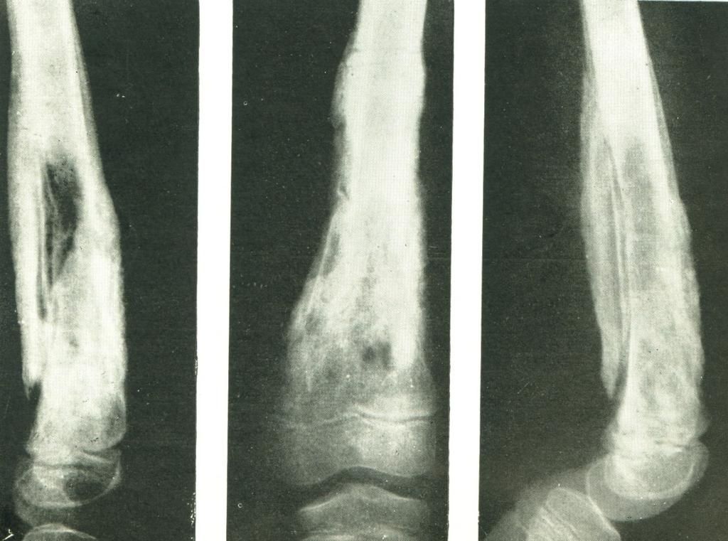 Osteomyelitis chronica RTG Kombinace prořídnutí a zhuštění