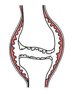 Patologická anatomie 2. Phlegmona pouzdra. Celá vrstva kl.