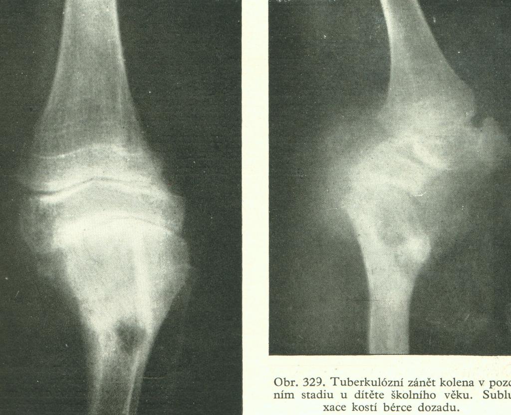 TBC artritis kolena,